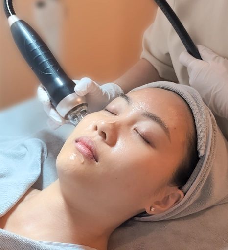 Baby Microneedling (RF Microneedling)